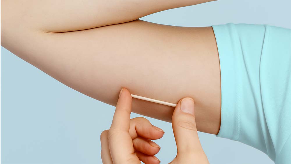 Lages passa a ofertar novo método contraceptivo subdérmico na rede municipal de saúde